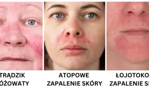 Jak rozpoznać cerę wrażliwą: objawy i skuteczne sposoby na pielęgnację