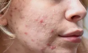 Jak wygląda zapchana cera? Objawy i skuteczne sposoby na leczenie