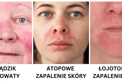 Jak rozpoznać cerę wrażliwą: objawy i skuteczne sposoby na pielęgnację