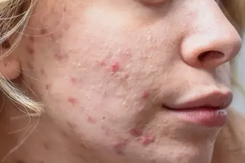 Jak wygląda zapchana cera? Objawy i skuteczne sposoby na leczenie