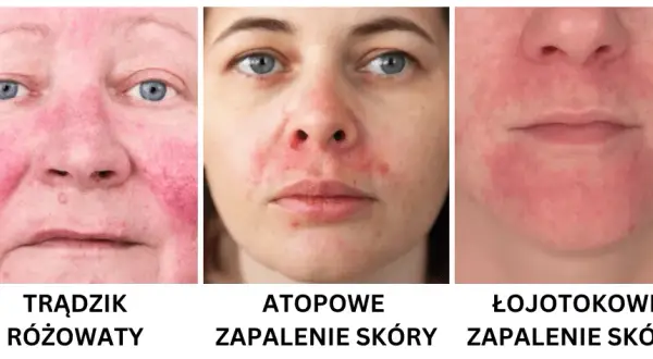 Jak rozpoznać cerę wrażliwą: objawy i skuteczne sposoby na pielęgnację