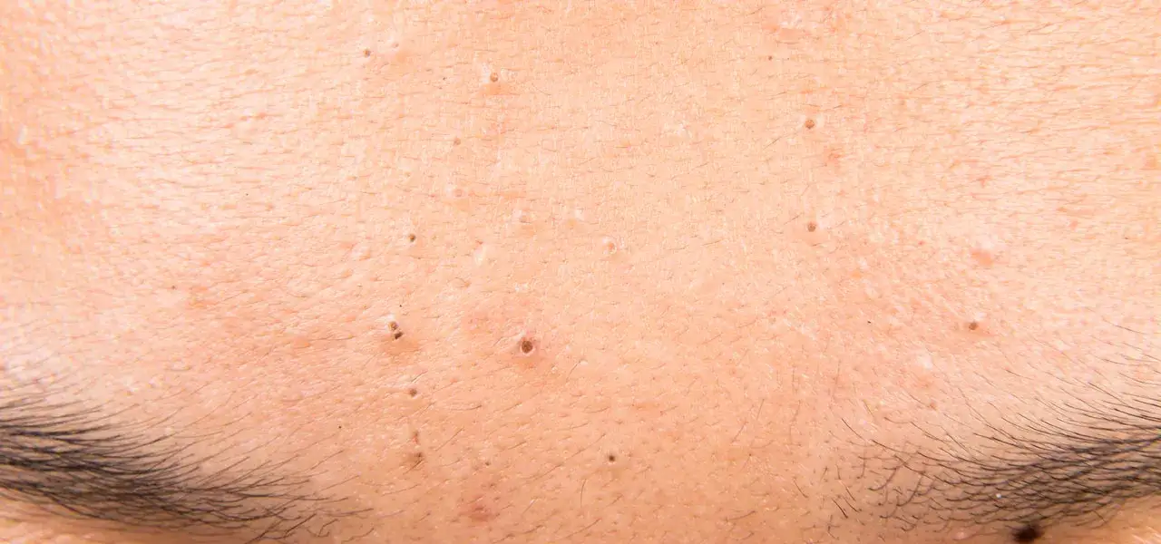 Zdjęcie Jak wygląda zapchana cera? Objawy i skuteczne sposoby na leczenie